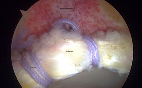 Repaired labrum with two anchors	Hip joint showing a good seal is formed by the repaired labrum around the femoral head - Mr Aslam Mohammed UK hip surgeon